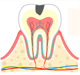 虫歯の進行具合