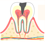 虫歯の進行具合